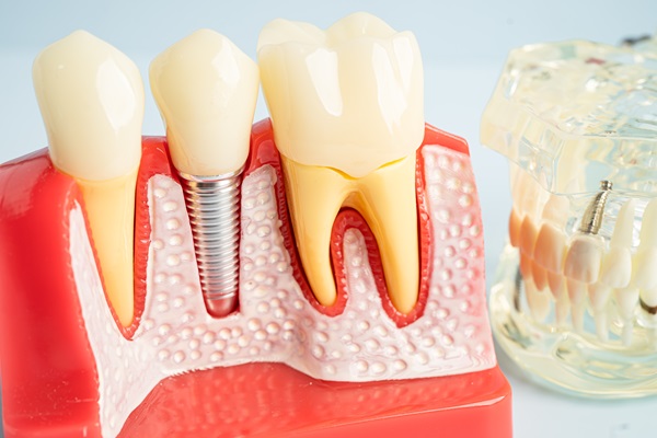 Are Dental Implants Safe?